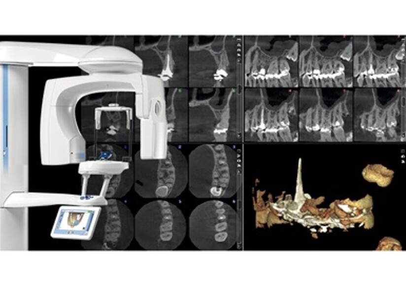 New endodontic imaging mode from Planmeca — detailed images without
