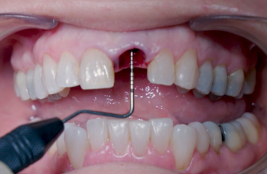Fig. 12: Final implant position assessment in relation to gingival margins.