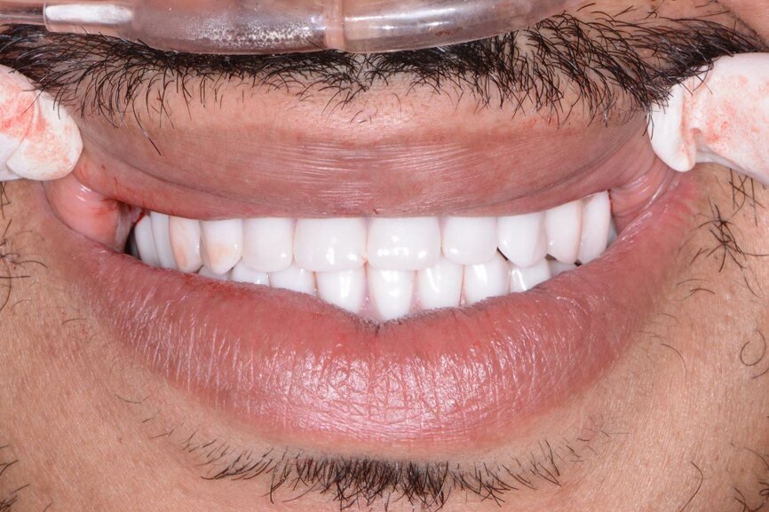 Fig. 20: Retracted post-op smile view.