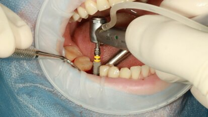 Review study compares machined and sandblasted dental implant surfaces