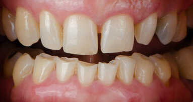 Compreender como o bruxismo afeta as restaurações dentárias
