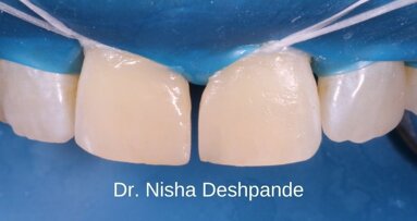 Front wing technique for direct diastema closures - Dr. Nisha Deshpande