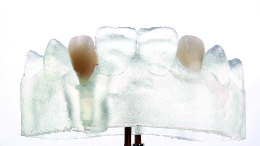 Fig. 20: Final restorations: Zirconium abutment screw with a ceramic facing and a fully anatomical Empress crown. 