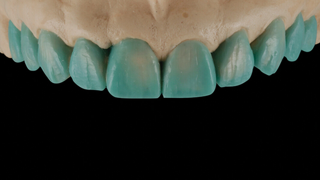 Fig. 4. Encerado en el modelo de piedra para la restauración de los diez dientes anteriores.
