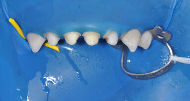 Edelweiss PEDIATRIC CROWNs: A new and innovative approach to restoring primary teeth