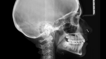 Ortodontická léčba komplexních případů malokluze pomocí průhledných alignerů