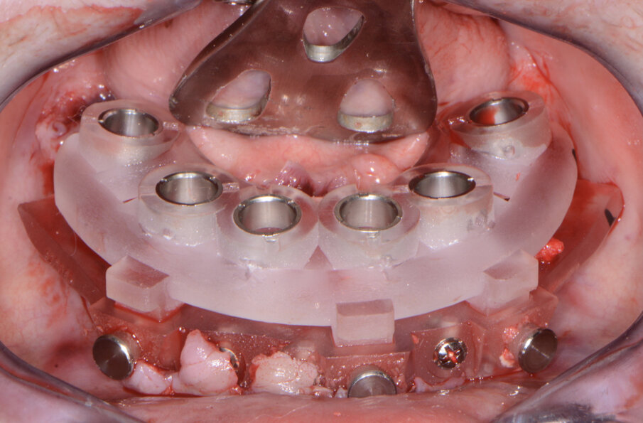 Fig. 13: Mandibular implant surgical guide.