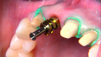 Immediate implantation and full-ceramic restoration in the maxillary anterior region