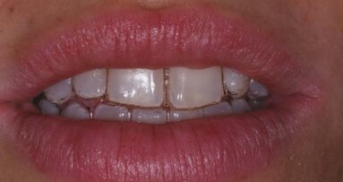 Protocolli di igiene orale per la bellezza e la salute del sorriso nel paziente ortodontico