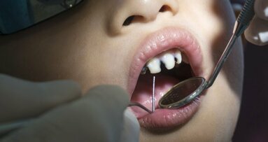 Cáries em crianças: Dentistas ingleses extraem 160 dentes um dia
