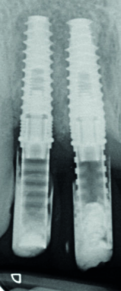 Fig. 9 : Radiographie « long-cône » de contrôle à trois mois. Notez la progression de la cicatrisation osseuse au niveau de l’implant en 12.
