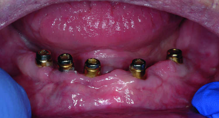 Fig. 2: Clinical image of patient. Note the wear of the metal abutments due to disengagement of the nylon retention inserts as a result of fulcrum during function.