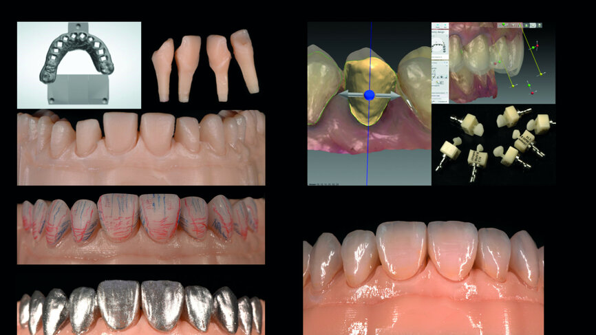 Definitive veneers and crowns prepared digitally using prosthetic