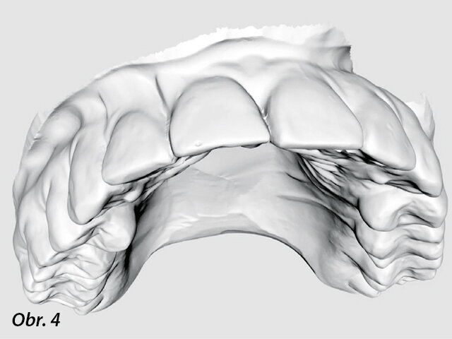 3D virtuální zubní model naskenovaný iTero.