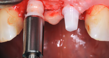 Bredent medical launches new generation of whiteSKY zirconia implants