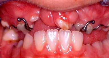 La figura dell’ortodontista nei pazienti con labiopalatoschisi