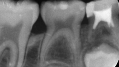 Il trattamento endodontico nel paziente pediatrico