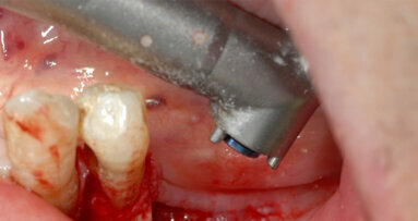 Il laser a Erbio in odontoiatria: applicazioni e vantaggi