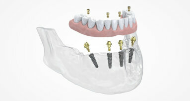 Neoss Group launches new multi-unit abutment for its Neoss4+ treatment solution