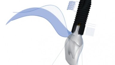 Dentsply Sirona – ASTRA TECH Implant System EV