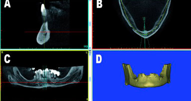 Guida alla riduzione ossea: concetti di pianificazione virtuale in 3D per protesi mandibolare full-arch su impianti