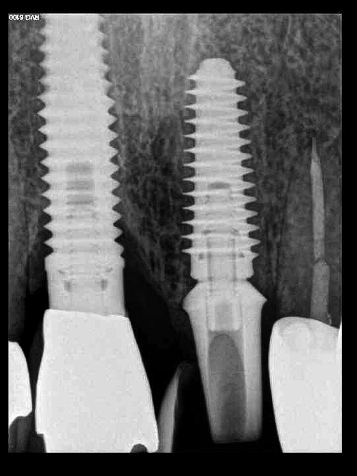 Fig. 26b: A post-op periapical radiograph confirmed successful sub-crestal placement of
this platform-switched design.