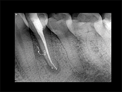 Slika 3: Nekrotičan/zaražen zub: donji premolar pacijenta koji se žali na konstantan, pulsirajući bol. Infekcija nije ograničena samo na apikalni deo već je takođe locirana i u srednjem delu lateralnog kanala. Postoperativni rendgenski snimak pokazuje 3-D zaptivanje apikalne regije sa svim anastomozama lateralnog i pomoćnih kanala.
