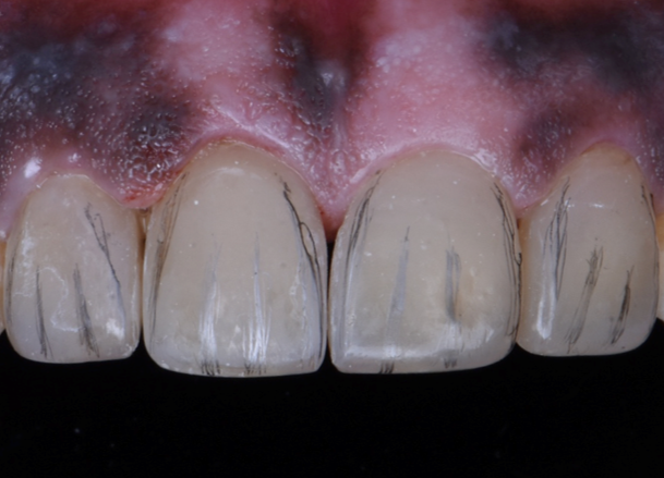 Step 6 – Contouring Restorations were marked with graphite to highlight  transitional lines, mesial - distal inclination and developmental grooves. Gross three dimensional contouring was done using diamond burs. Interdental finishing strips were used to remove excess and shape emergence profile of the teeth. 