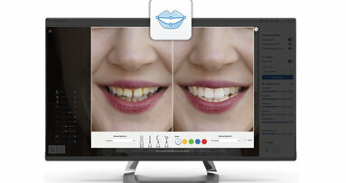 Medit Smile Design can show patients their future smile