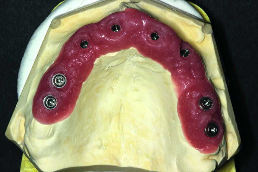 Fig. 19: A model with a gingival mask.