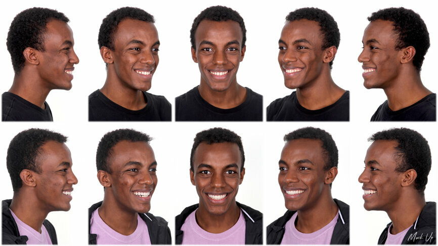 Fig. 50: Mock-up procedures and result in the mouth in order to evaluate the aesthetic relation between the face and the smile.