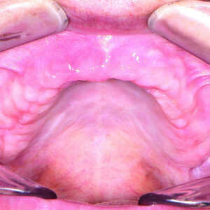 Fig-17-Crête-maxillaire-quatre-mois-après-l’intervention-300x300-
