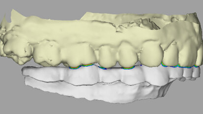 Impression 3D : la nouvelle mode en chirurgie dentaire ?