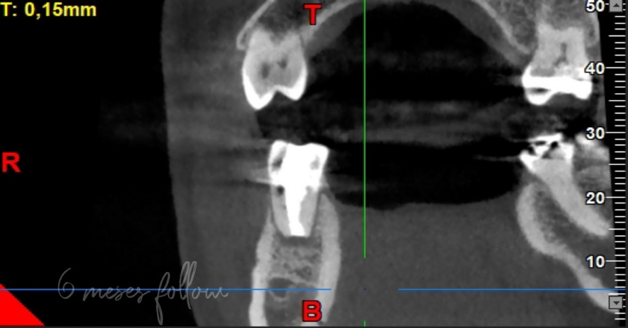 Fig. 6 - Sezione sagittale della scansione CBCT sei mesi dopo il trattamento che mostra una guarigione quasi completa della lesione periapicale.