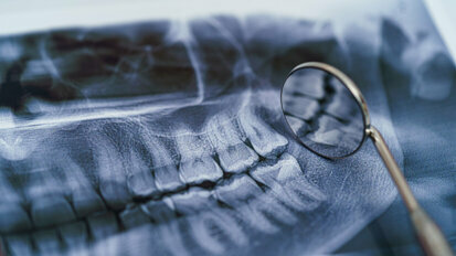 KI interpretiert Röntgenbilder in der Zahnmedizin