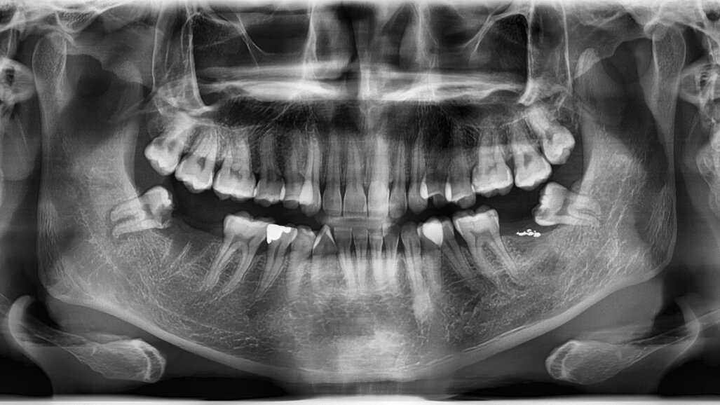 Avaliação de idade bem conhecida usando terceiros molares não é apoiada cientificamente, diz estudo