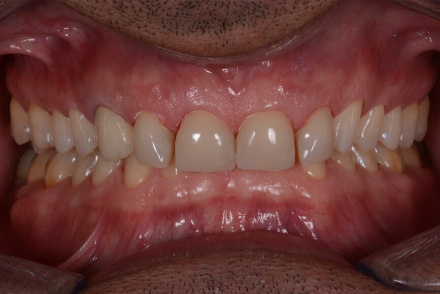 Fig. 1: Intraoral photograph prior to treatment, frontal view.