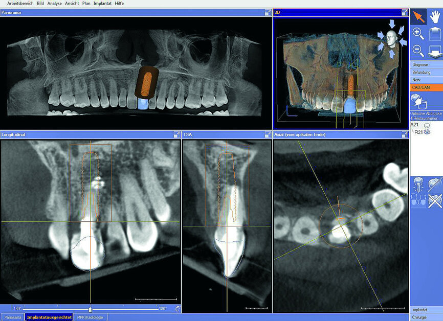 Fig. 6: The intraoral CEREC scan superimposed over 3-D image data for optimal positioning of the implant in the Galileos Implant planning software.