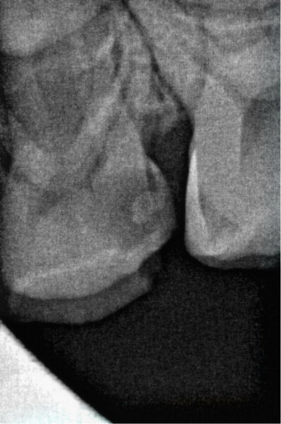 Fig. 2: Pre-op radiograph of tooth #64. (Image: Dr Anne Heinz)
