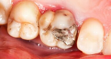 牙科临床中应当逐渐停止使用银汞合金
