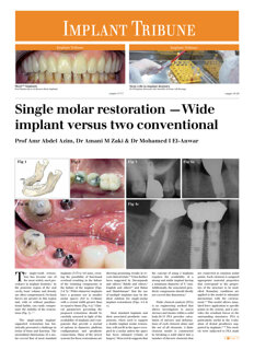 Implant Tribune UK No. 1, 2014