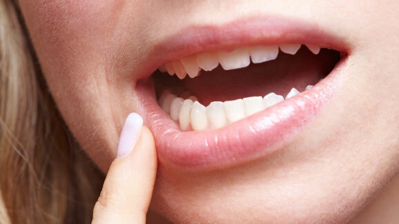 Le calcium contenu dans les gels de blanchiment des dents, réduirait la sensibilité dentaire