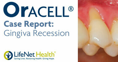 Patient with severe gum recession treated with Oracell.