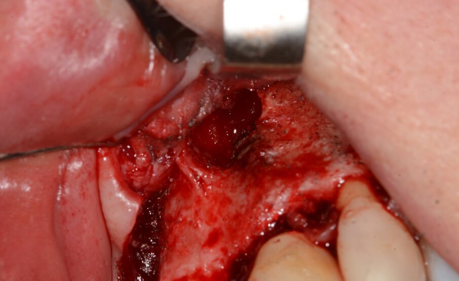 Fig. 17: Ressecção do implante.