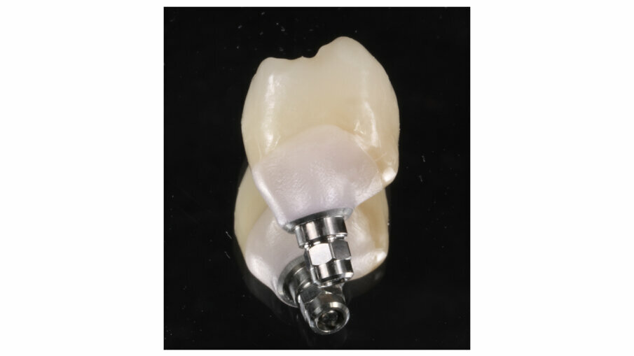 Fig. 3: Hybrid implant crown made with zirconia mesostructure and BRILLIANT Crios cemented adhesively on top ready to be screwed in mouth.