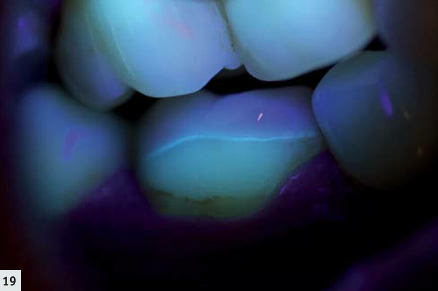 Fig. 19 : Même dent que sur la Fig. 18. La fine ligne du scellement (G-ænial Antérior, teinte A2) est visible grâce à l’utilisation de D-Light Pro en mode détection. Les limites marginales présentent une excellente adaptation et sont exemptes de caries.
