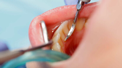 Badanie dostarcza nowych informacji na temat rozwoju i profilaktyki próchnicy zębów