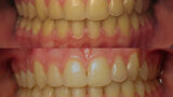 Figura 10. Caso clínico antes y después de un blanqueamiento dental con cubetas listas para usar.
