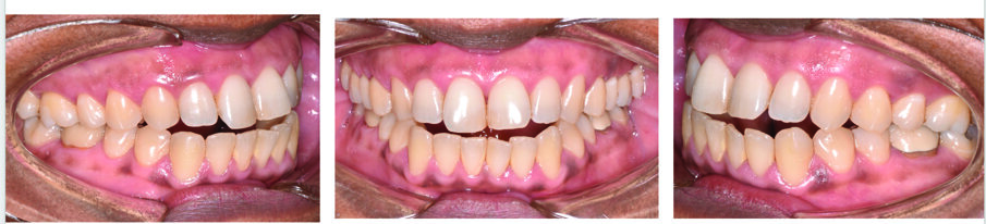 Fig. 12. Patient S. P., a 54-year-old with a Class III anterior open bite.