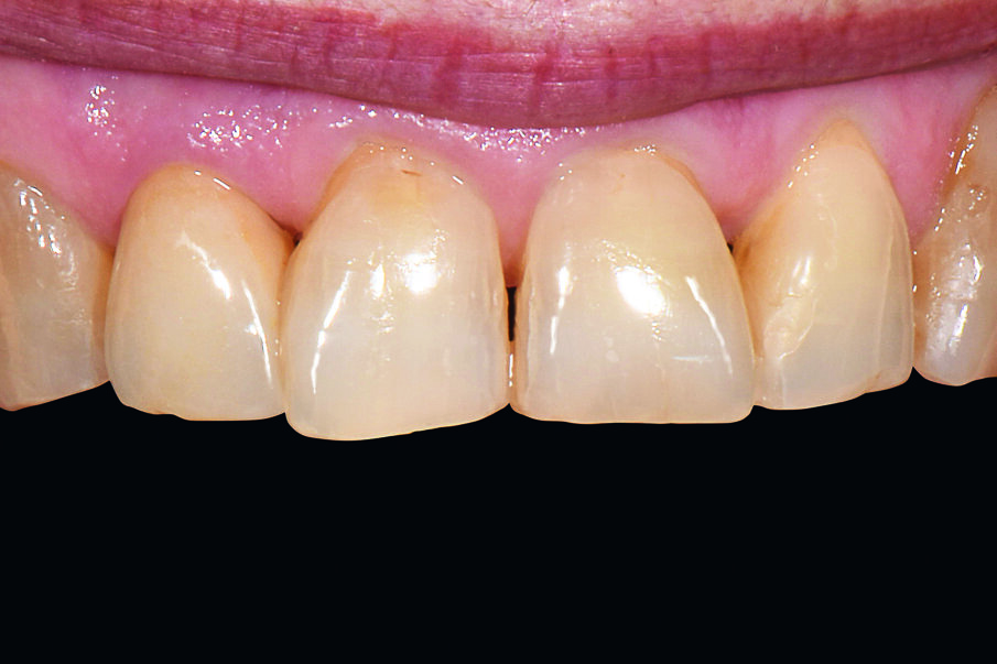 Fig. 6: Result: The crown was polished and finally integrated. The restoration harmonized with the remaining tooth substance.